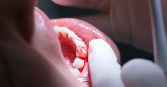 why do my gums bleed now ive switched to vaping