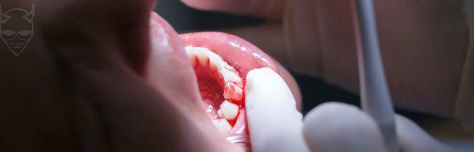 why do my gums bleed now ive switched to vaping